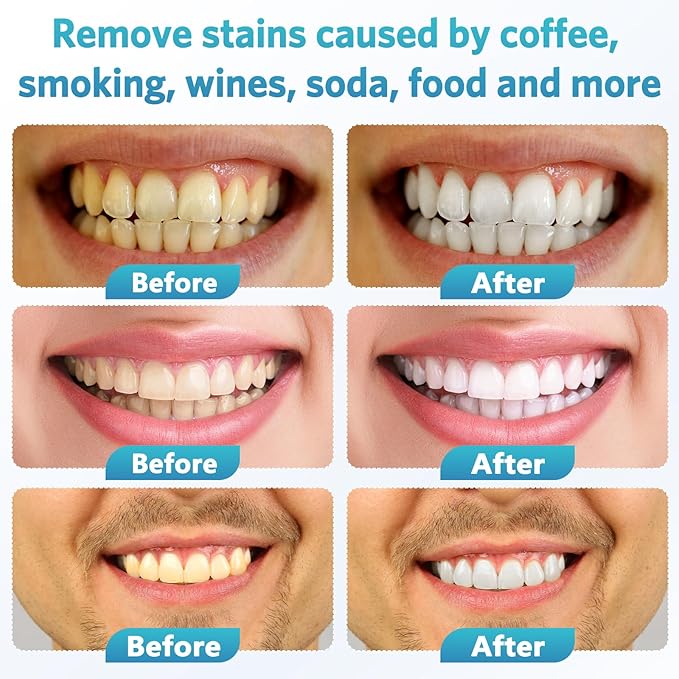 BESTEK Teeth Whitening Kit – 32X LED Light, 10-Min Fast Whitening, 4 Tubes of 35% Carbamide Peroxide Gel, Removes Coffee, Wine & Tobacco Stains - White